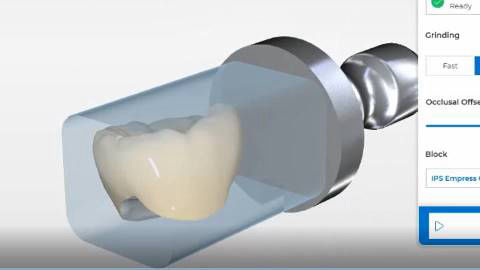 Ceramic Crown Design using 3D Cad Cam Dental Tech