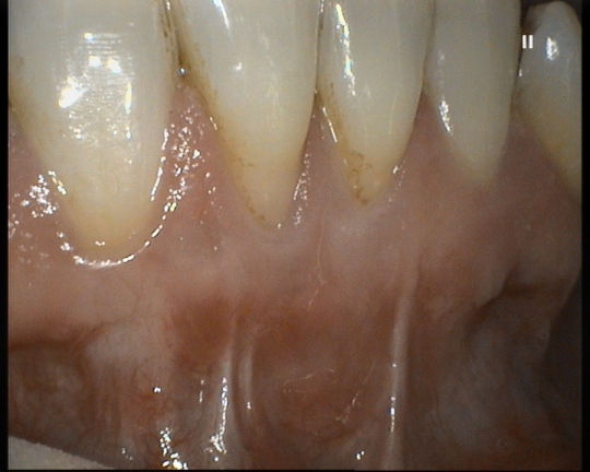 Gingivitis Healed After Gum Tissue Graft Tooth Root Is No Longer Exposed