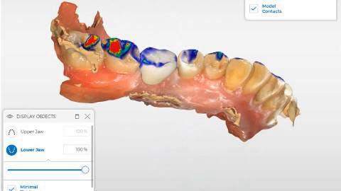 New Ceramic Dental Crown Placed Perfectly by CAD CAM System