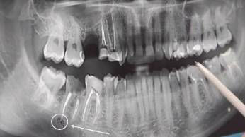 Apicoectomy Root Canal Fail