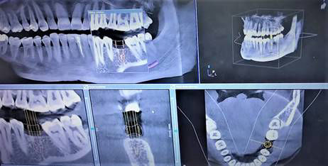 Dental Implants Planning Placement