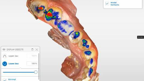 Dental Tech Cad Cam New Tooth With Bite Impressions