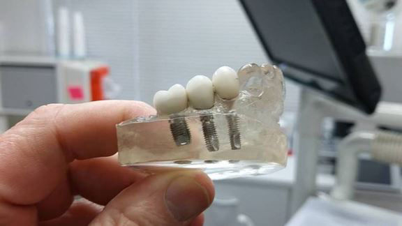 Different Titanium Screw Sizes for Dental-Implants