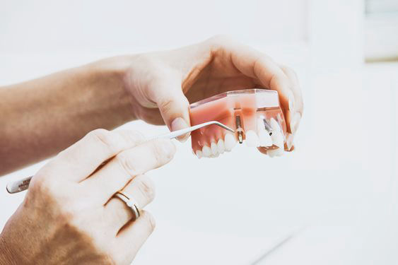 Implant Dentures