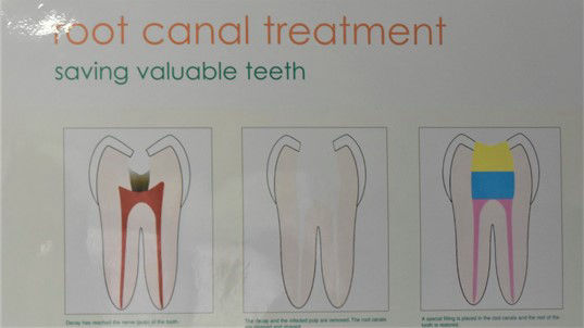 Preparation For A Dental Root Canal Treatment