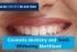 Teeth Bleaching Whitening 